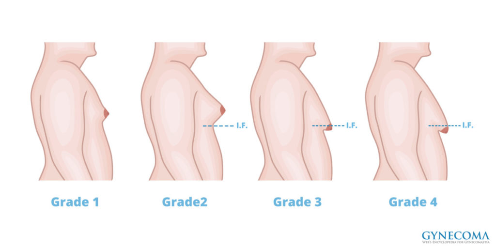 types-or-grades-of-gynecomastia